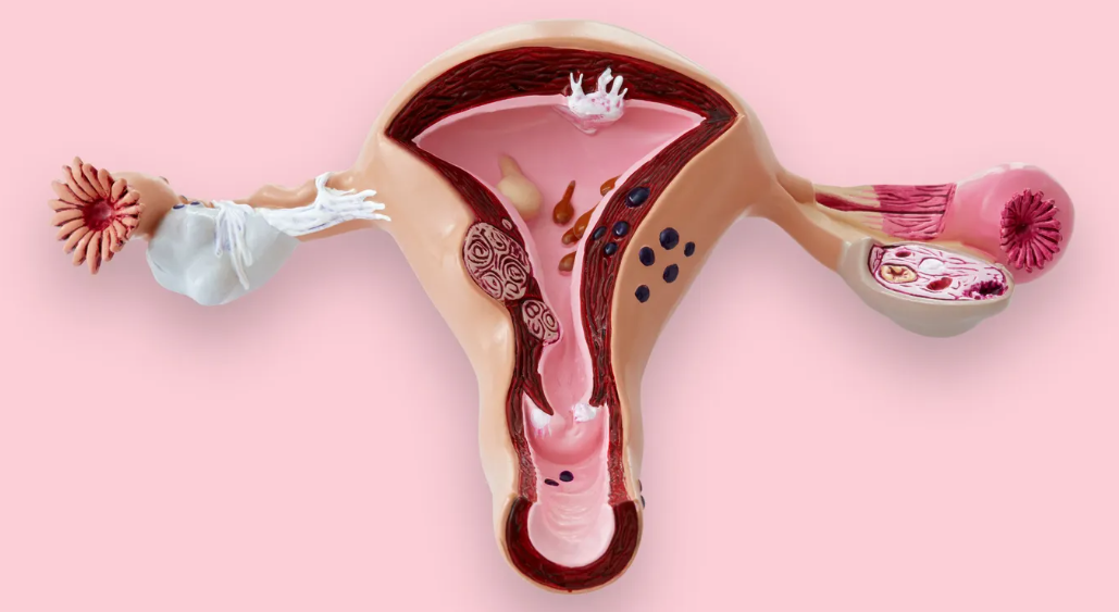 Screen shot of article cover photo: Who Decides Who Gets A Hysterectomy?